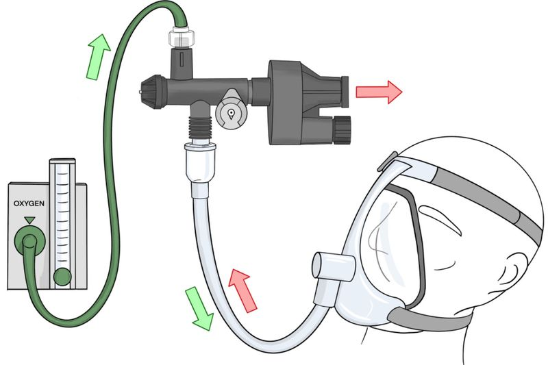 Um diagrama do Illinois RapidVent desenvolvido por engenheiros da Universidade de Illinois em Urbana-Champaign mostra como o produto funcionaria quando conectado a um paciente para ajudá-lo a respirar.